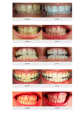 AuraGlow Teeth Whitening Kit, LED Light, 35% Carbamide Peroxide, (2) 5ml Gel Syringes, Tray and Case